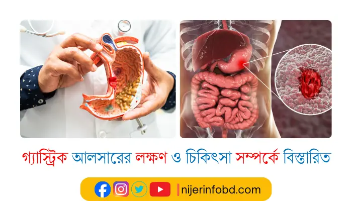 গ্যাস্ট্রিক আলসারের লক্ষণ ও চিকিৎসা সম্পর্কে বিস্তারিত