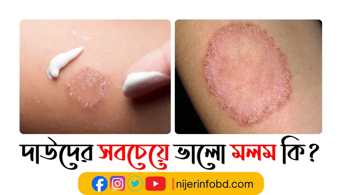 দাউদের সবচেয়ে ভালো মলম কি?