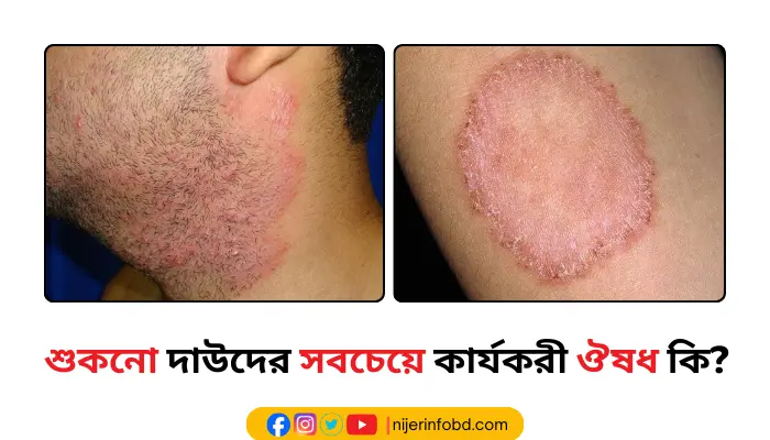 শুকনো দাউদের সবচেয়ে কার্যকরী ঔষধ কি? দাউদের চিকিৎসা
