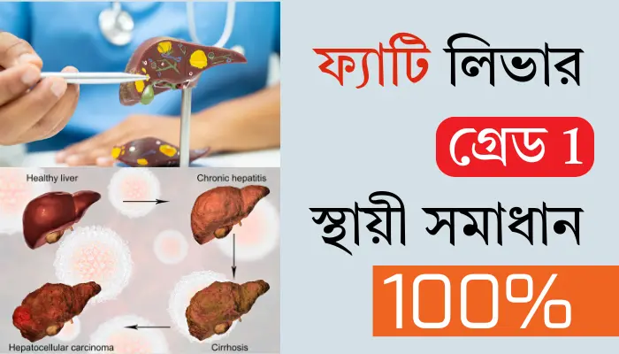ফ্যাটি লিভার গ্রেড 1 এর চিকিৎসা ও এর ১০০% স্থায়ী সমাধান